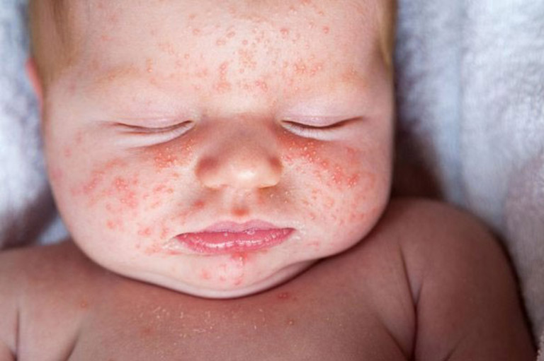 Trẻ bị rôm sảy: Nguyên nhân, dấu hiệu và cách xử lý