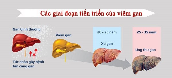 Viêm gan B - Căn bệnh truyền nhiễm ít người biết đến